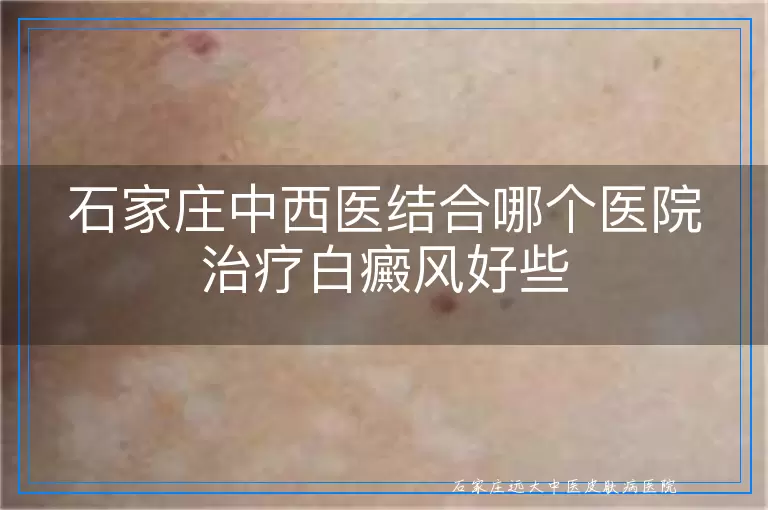 石家庄中西医结合哪个医院治疗白癜风好些