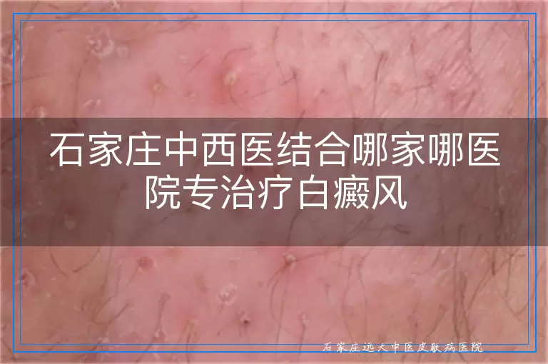 石家庄中西医结合哪家哪医院专治疗白癜风