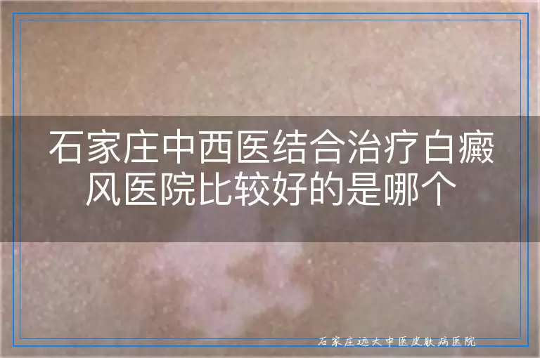 石家庄中西医结合治疗白癜风医院比较好的是哪个