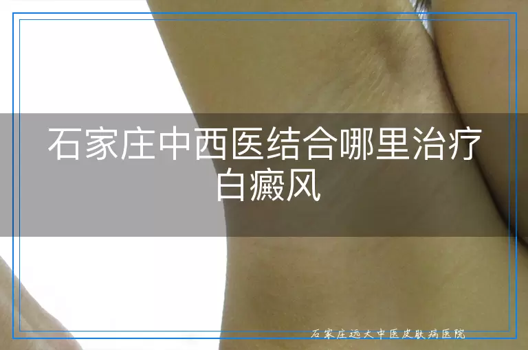 石家庄中西医结合哪里治疗白癜风