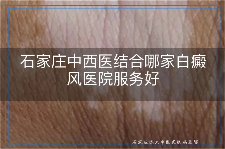 石家庄中西医结合哪家白癜风医院服务好