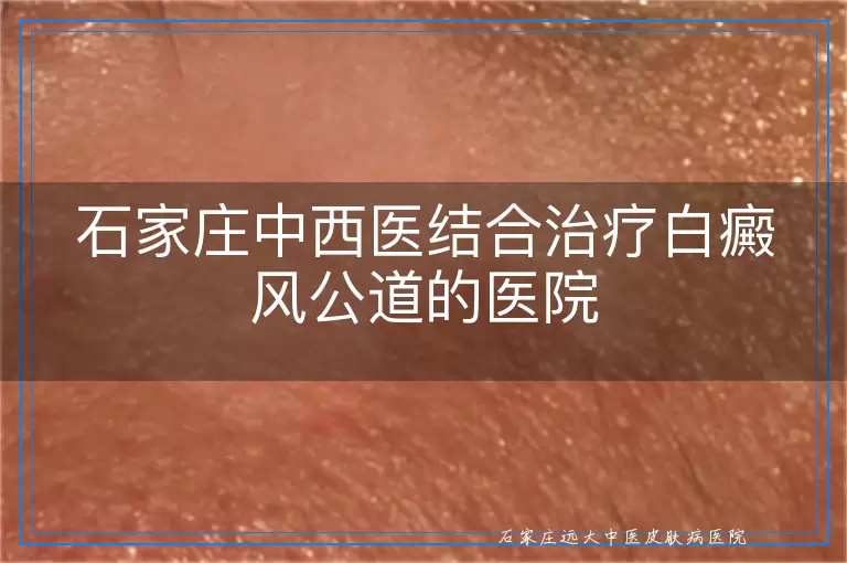 石家庄中西医结合治疗白癜风公道的医院
