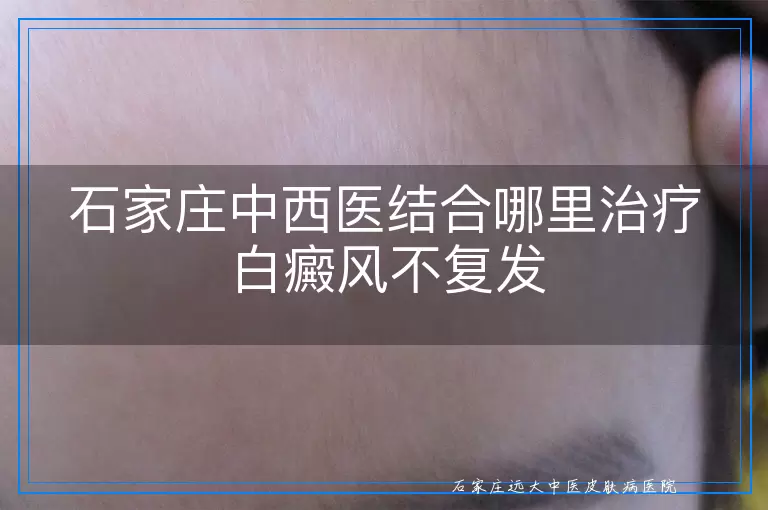 石家庄中西医结合哪里治疗白癜风不复发