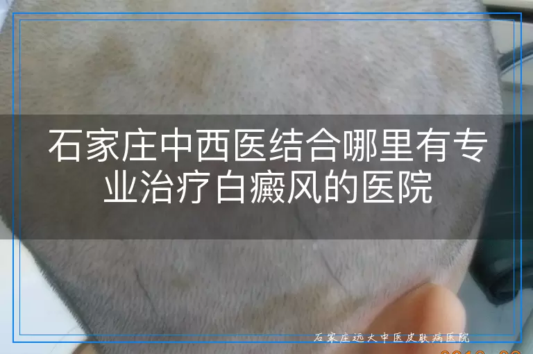 石家庄中西医结合哪里有专业治疗白癜风的医院