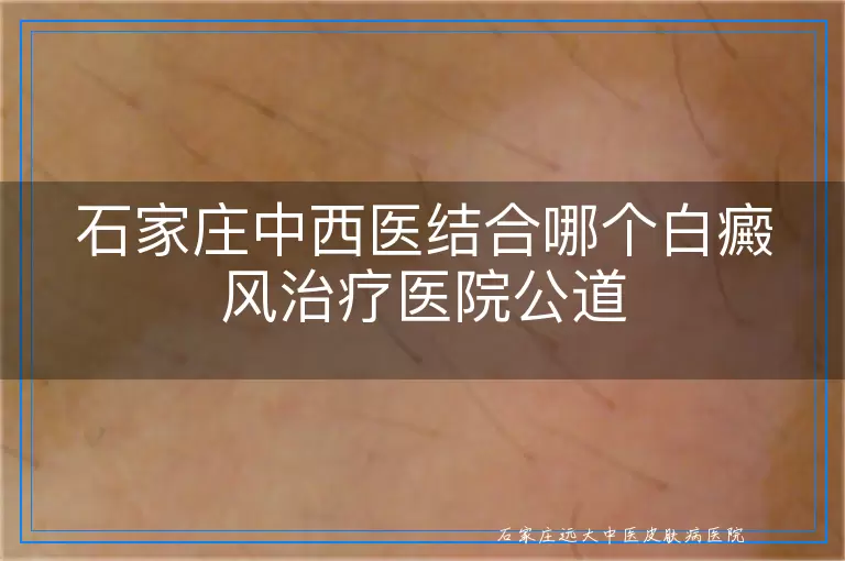 石家庄中西医结合哪个白癜风治疗医院公道