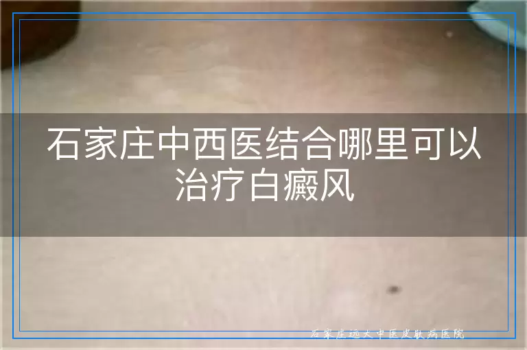 石家庄中西医结合哪里可以治疗白癜风