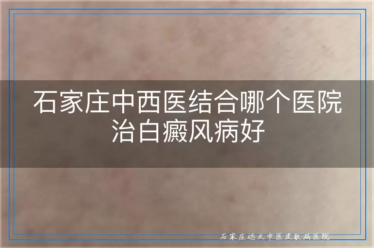 石家庄中西医结合哪个医院治白癜风病好
