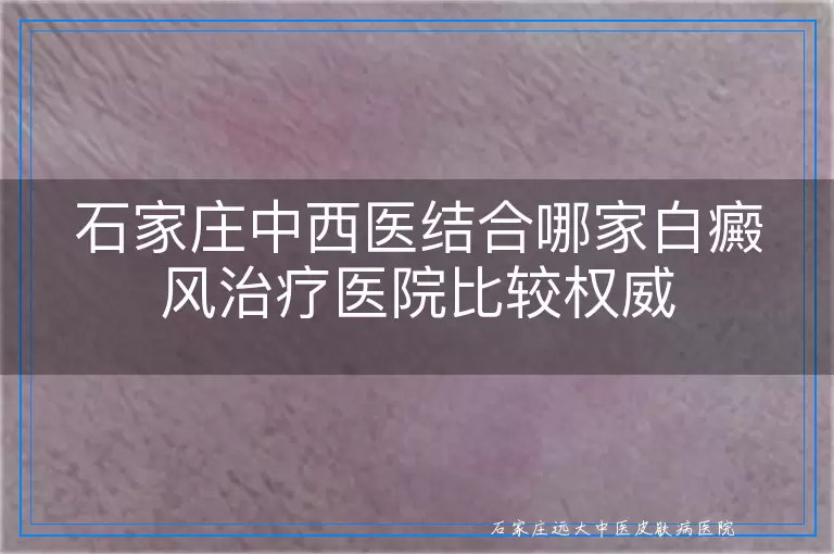 石家庄中西医结合哪家白癜风治疗医院比较权威
