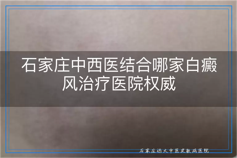 石家庄中西医结合哪家白癜风治疗医院权威