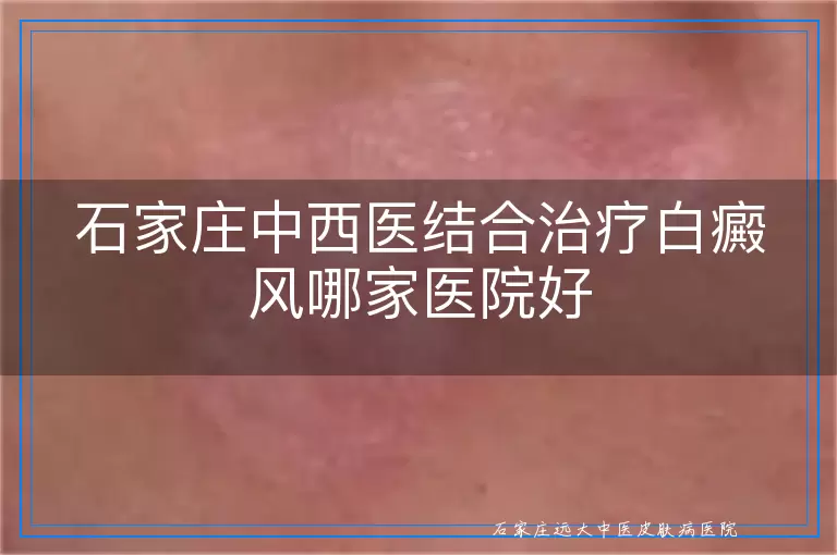 石家庄中西医结合治疗白癜风哪家医院好