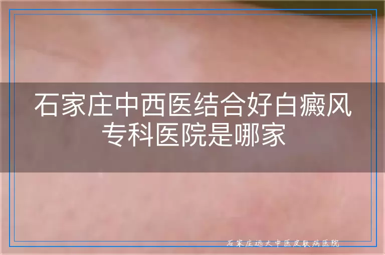 石家庄中西医结合好白癜风专科医院是哪家