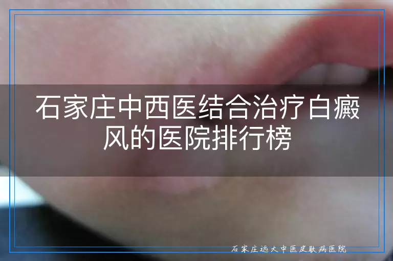 石家庄中西医结合治疗白癜风的医院排行榜