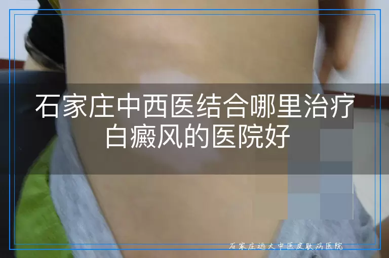 石家庄中西医结合哪里治疗白癜风的医院好