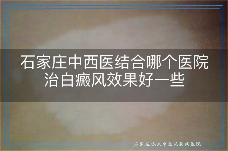 石家庄中西医结合哪个医院治白癜风效果好一些