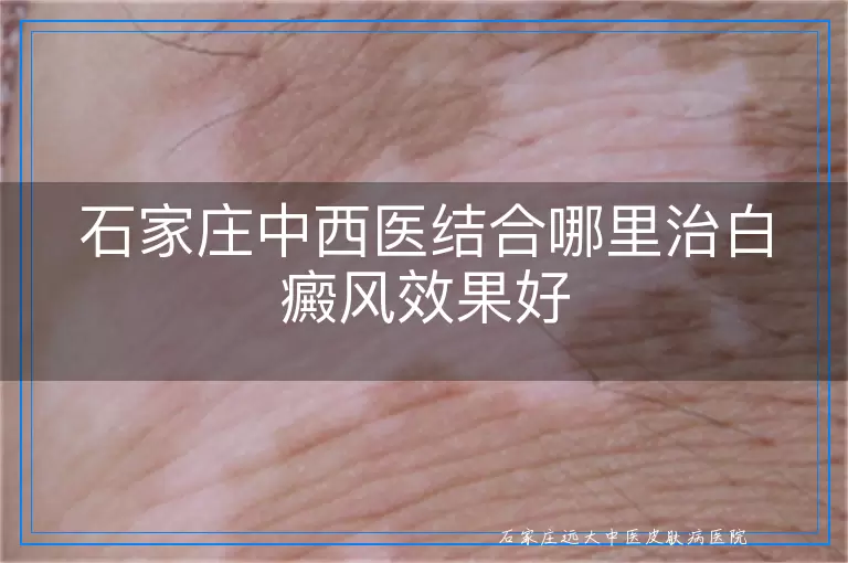 石家庄中西医结合哪里治白癜风效果好