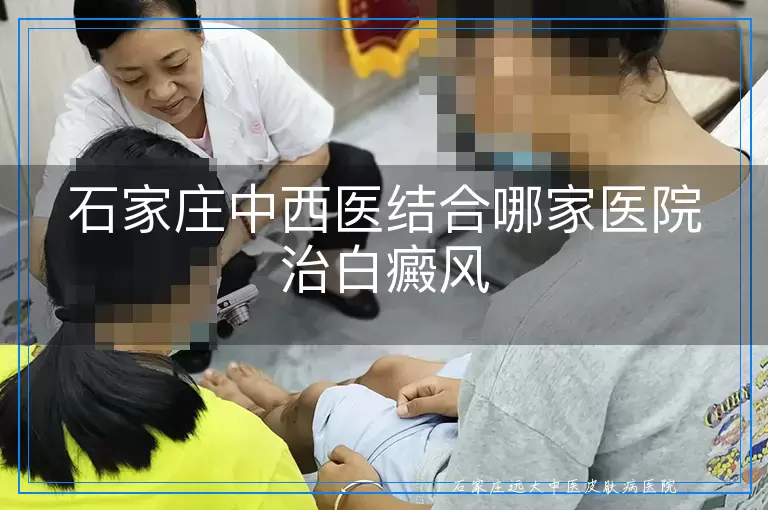 石家庄中西医结合哪家医院治白癜风