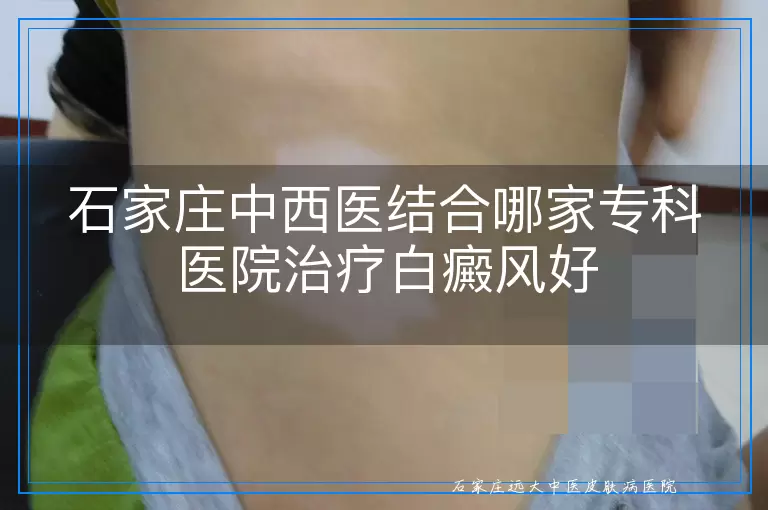 石家庄中西医结合哪家专科医院治疗白癜风好