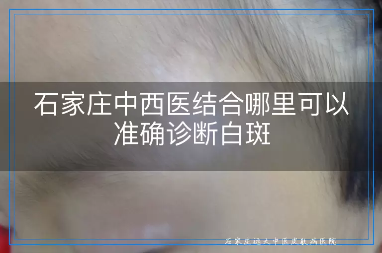 石家庄中西医结合哪里可以准确诊断白斑
