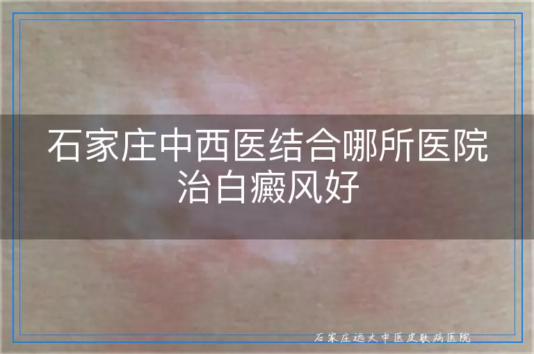 石家庄中西医结合哪所医院治白癜风好
