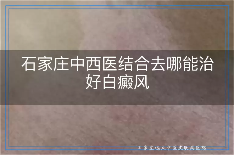 石家庄中西医结合去哪能治好白癜风