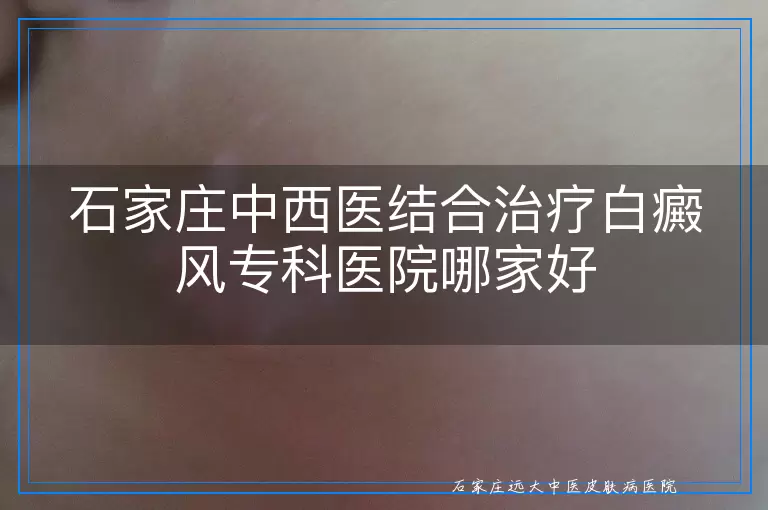石家庄中西医结合治疗白癜风专科医院哪家好