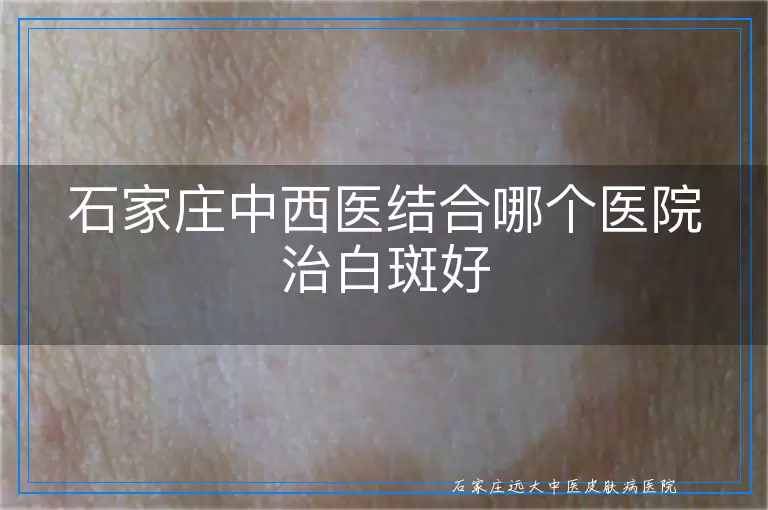 石家庄中西医结合哪个医院治白斑好