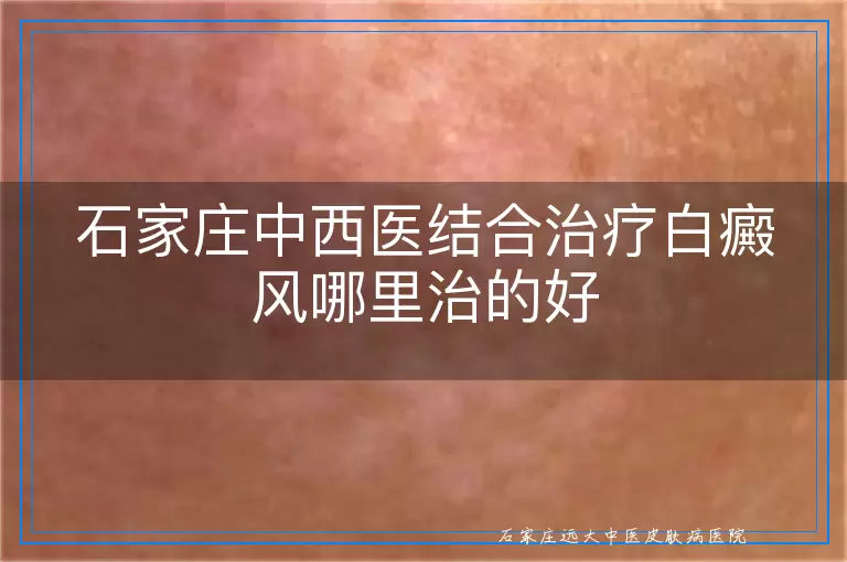 石家庄中西医结合治疗白癜风哪里治的好