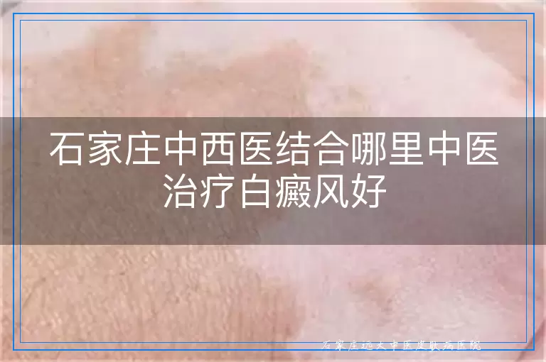 石家庄中西医结合哪里中医治疗白癜风好