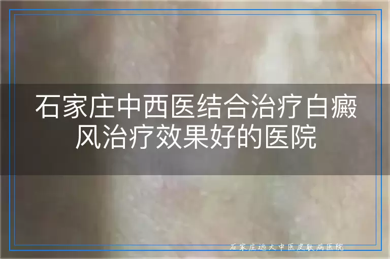 石家庄中西医结合治疗白癜风治疗效果好的医院