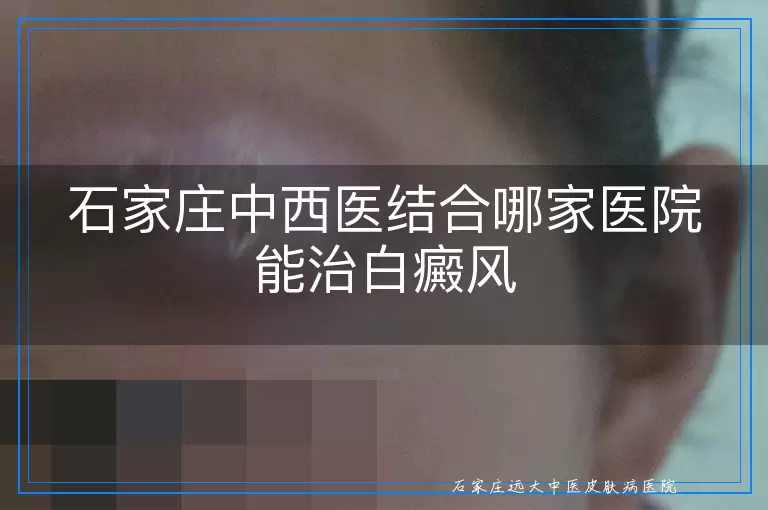 石家庄中西医结合哪家医院能治白癜风