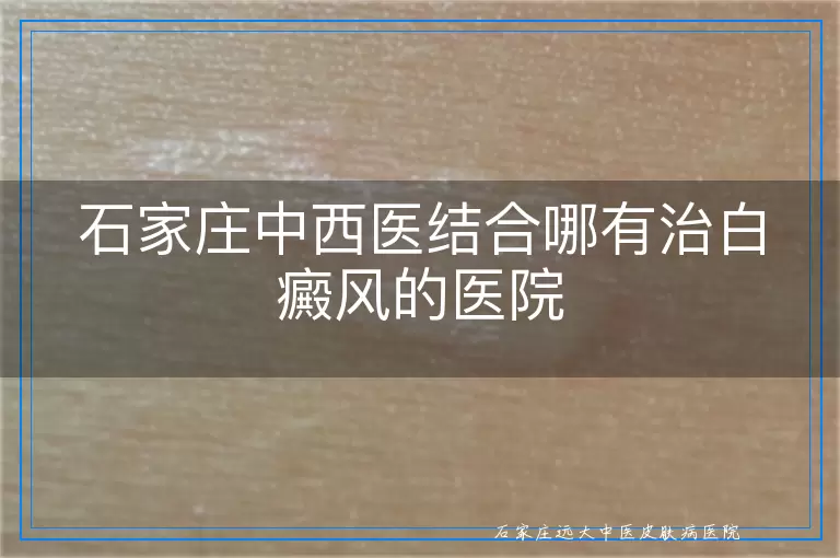 石家庄中西医结合哪有治白癜风的医院