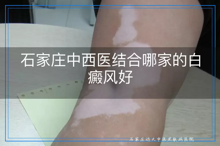 石家庄中西医结合哪家的白癜风好