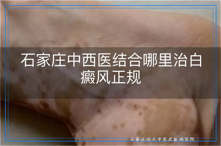 石家庄中西医结合哪里治白癜风正规