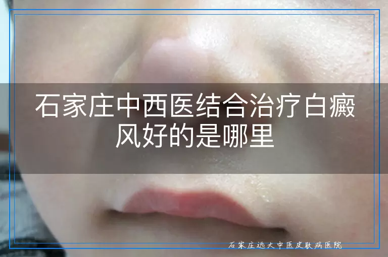 石家庄中西医结合治疗白癜风好的是哪里