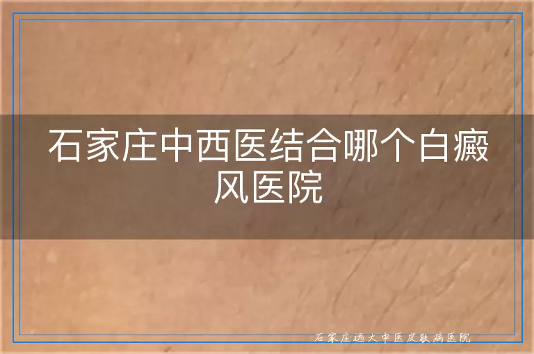 石家庄中西医结合哪个白癜风医院
