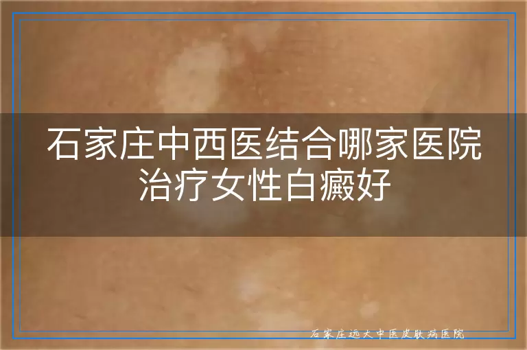 石家庄中西医结合哪家医院治疗女性白癜好