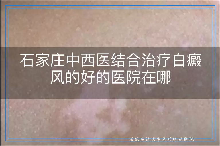 石家庄中西医结合治疗白癜风的好的医院在哪