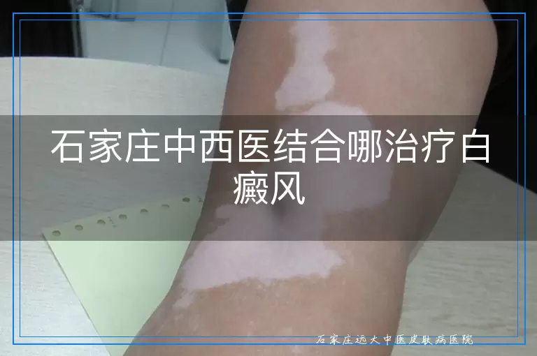 石家庄中西医结合哪治疗白癜风