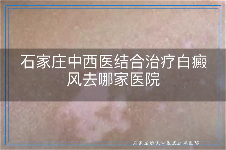 石家庄中西医结合治疗白癜风去哪家医院