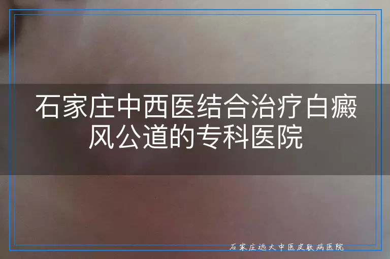 石家庄中西医结合治疗白癜风公道的专科医院