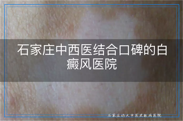 石家庄中西医结合口碑的白癜风医院