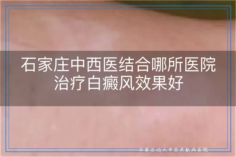 石家庄中西医结合哪所医院治疗白癜风效果好