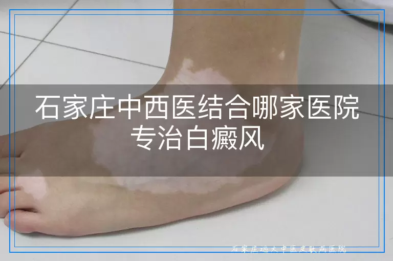 石家庄中西医结合哪家医院专治白癜风