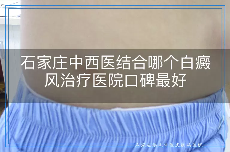 石家庄中西医结合哪个白癜风治疗医院口碑最好