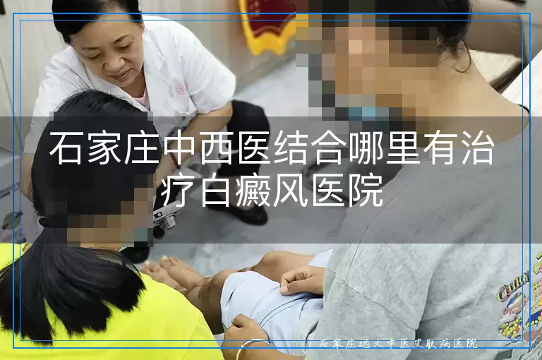 石家庄中西医结合哪里有治疗白癜风医院