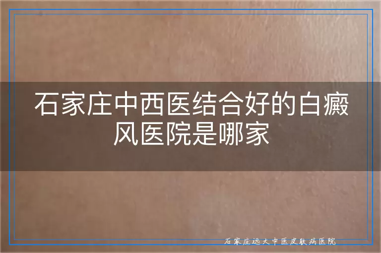 石家庄中西医结合好的白癜风医院是哪家
