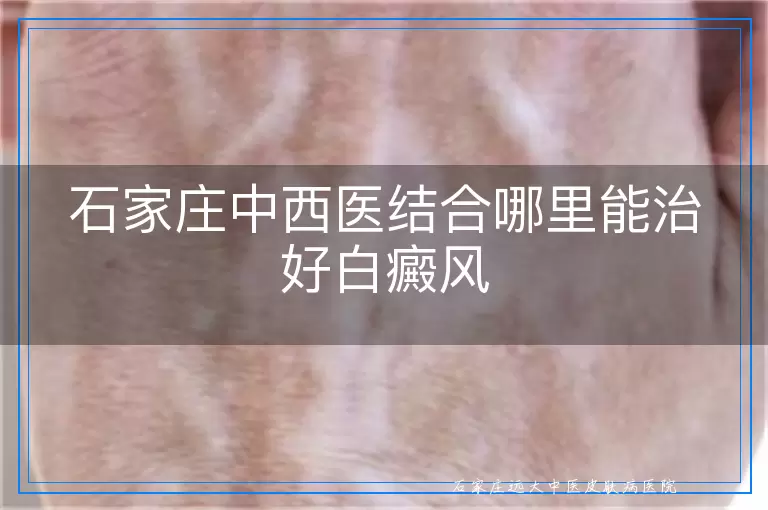 石家庄中西医结合哪里能治好白癜风