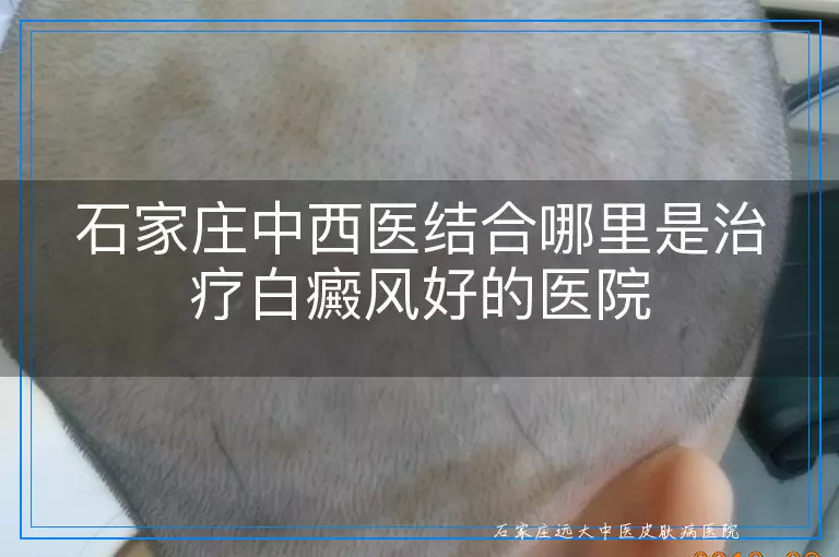 石家庄中西医结合哪里是治疗白癜风好的医院