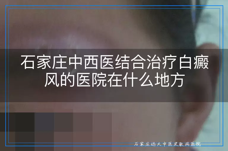 石家庄中西医结合治疗白癜风的医院在什么地方