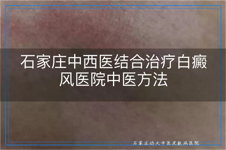 石家庄中西医结合治疗白癜风医院中医方法